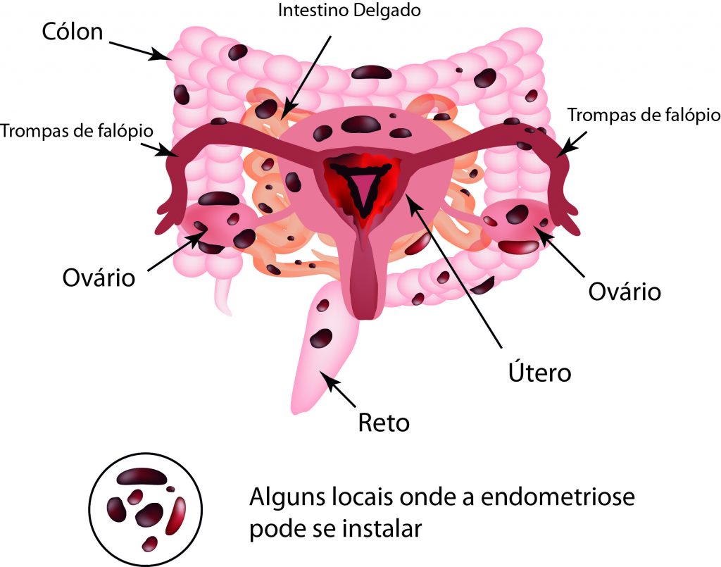 Ilustração de locais do corpo onde a endometriose pode se instalar