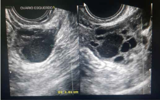 Ultrassom transvaginal com preparo intestinal